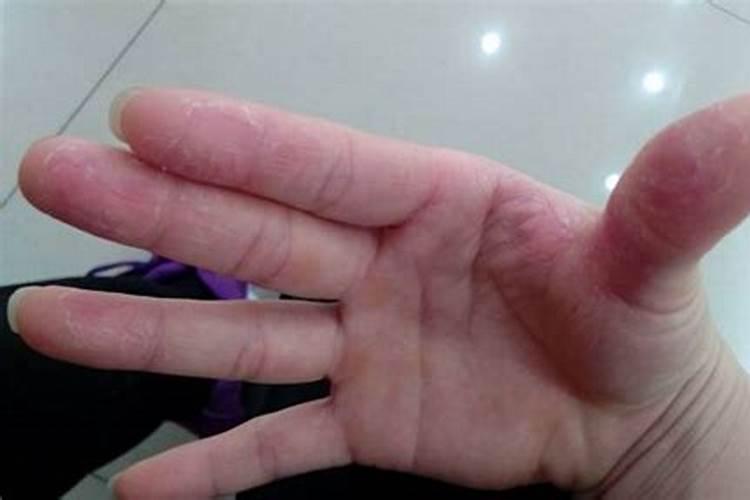 梦见脱皮是什么意思？做梦梦见脱皮好不好