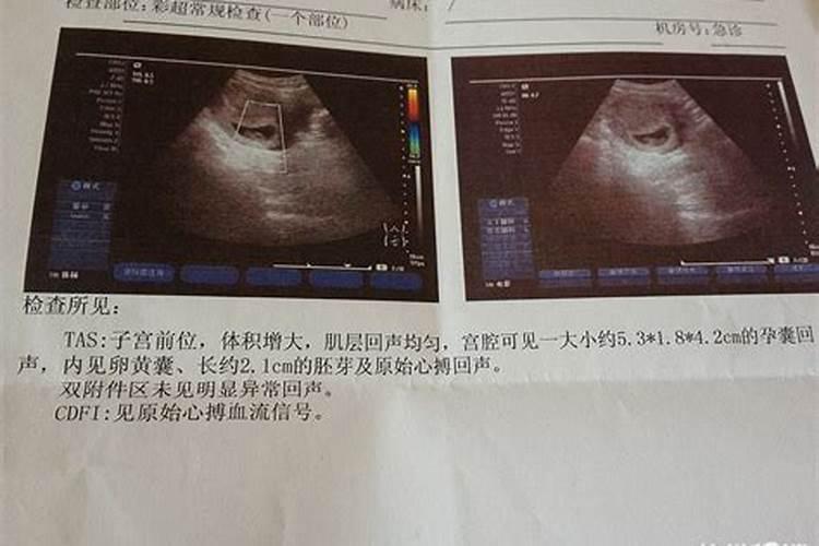 怀孕55天能药物流产吗,怀孕55天人工流产痛吗