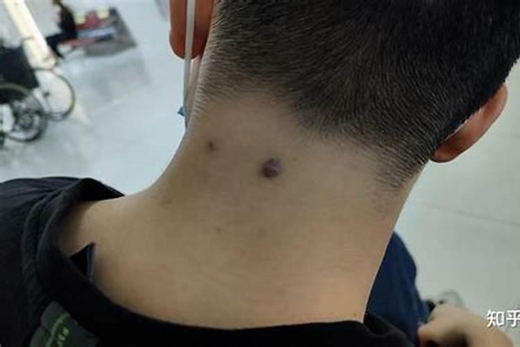 痣的位置与命运解析 脖子后面有痣代表什么
