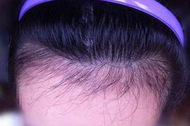女人梦见头发发际线后移