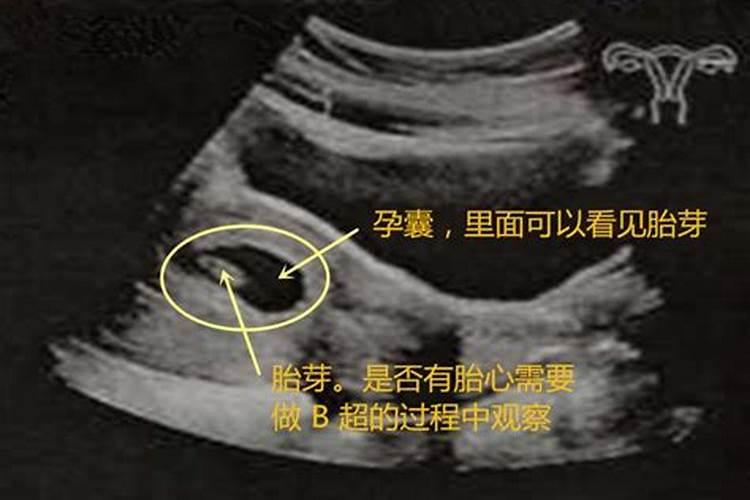 ...怀孕六十天,宝宝没有胎心,进行药流的,有的