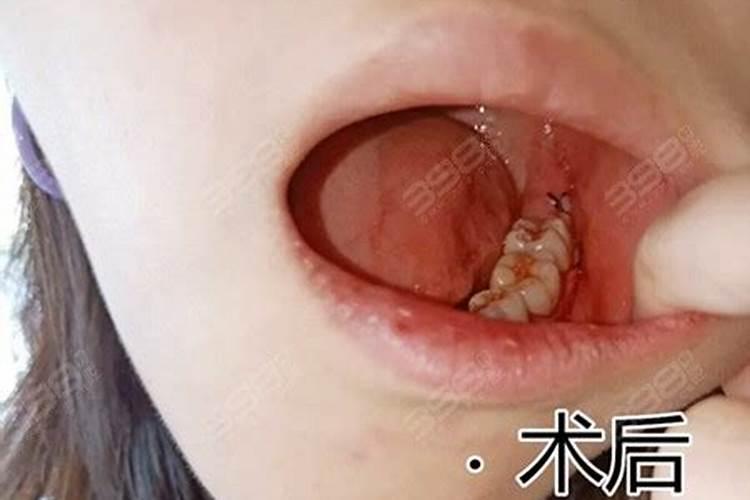 正月十五拔牙好不好