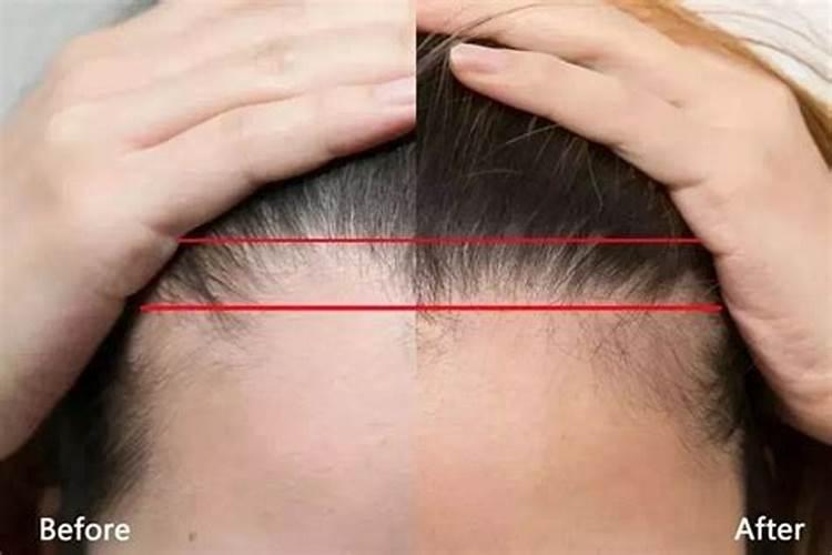 发际线太低会影响我们运势吗