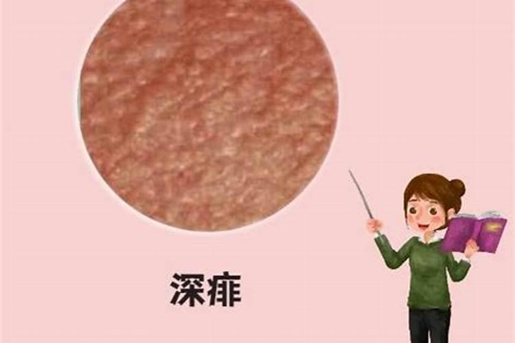 屁股有痦子代表什么