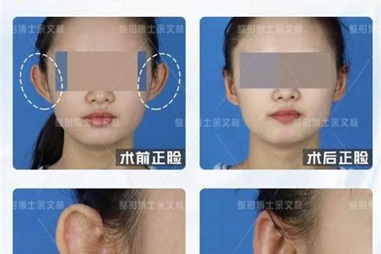 贴面耳和招风耳哪个好贴面耳贵人相伴左右？